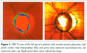 Figure 1 left panel: surface map (topography) right panel: false colour reflectivity image